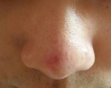 卵巢囊腫怎么形成的