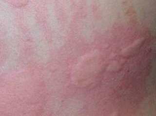 引起尿道炎的病因是什么