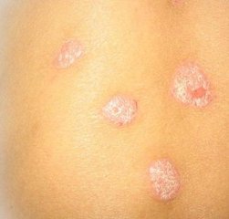 宮頸糜爛有哪些癥狀表現(xiàn)