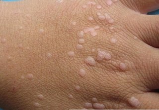 宮頸息肉早期會(huì)有什么表現(xiàn)