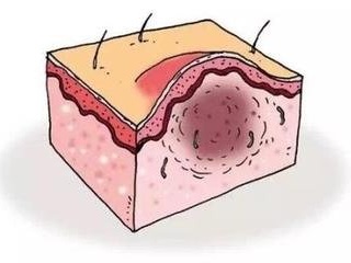 宮頸肥大患者要如何護(hù)理