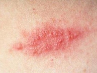 子宮肌瘤是怎么引起的呢