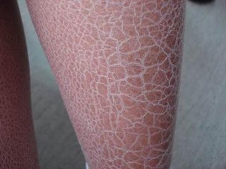 閉經(jīng)痛經(jīng)患者的日常護(hù)理